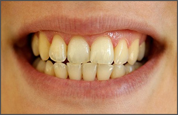 Tooth Discolorization